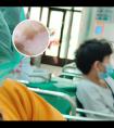 308准分子光治疗的收费价格